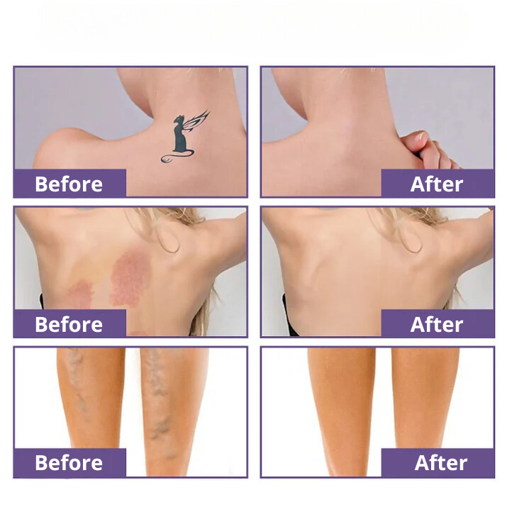 Invisiblend™ | Full imperfections coverage!